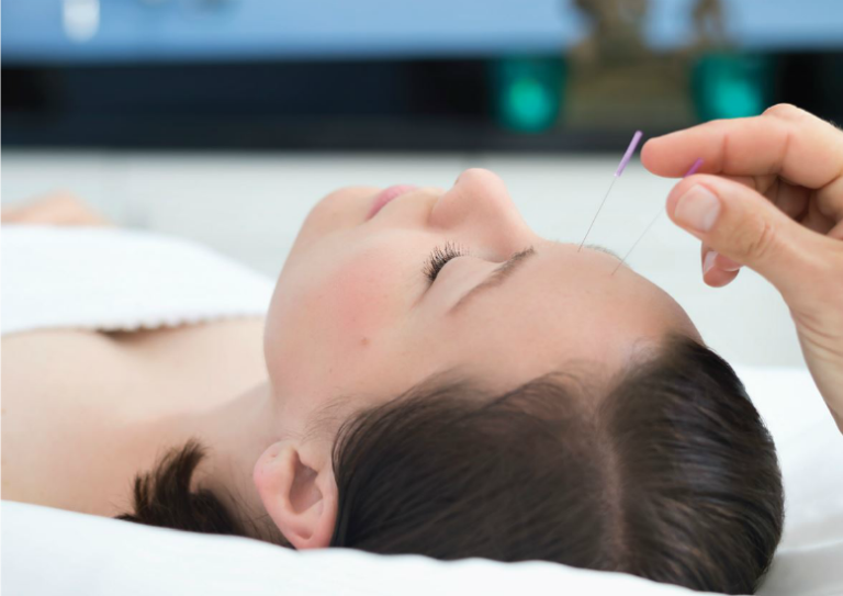 lady with acupuncture needles in head looking relaxed