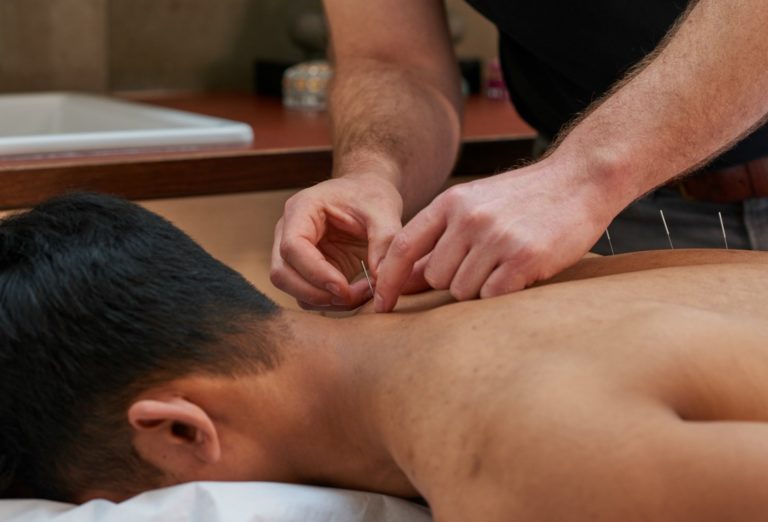 man laying on front with acupuncture needles in back, triyoga