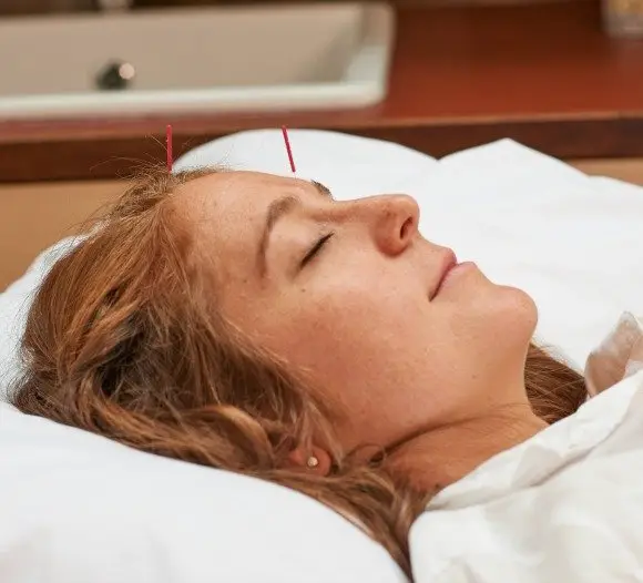 A lady undergoing acupuncture treatment and other holistic treatment in London