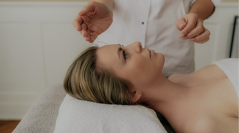 Woman receiving acupuncture treatment.