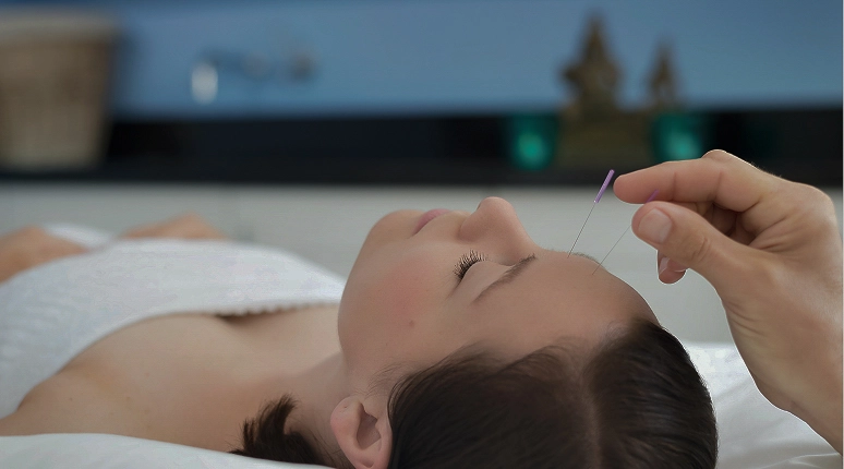 Acupuncture treatment on a woman's forehead.