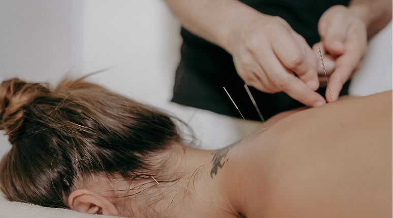 Acupuncture treatment on a person's back.